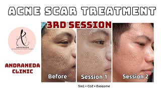 Acne Scar Treatment with Subcision amp TCA Cross  Andraneda Clinic  Philippines [upl. by Nyvlem680]