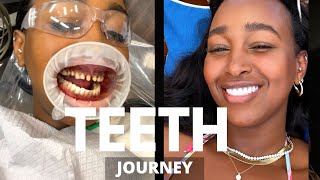 MY TEETH JOURNEY  I GOT PORCELAIN VENEERS  BEFORE AND AFTER PHOTOS  DR NEAL PATEL  THE YUSUFS [upl. by Deane490]