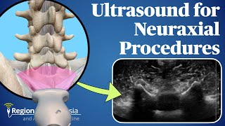 Ultrasound for Neuraxial Procedures [upl. by Rochell]