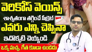 Varicose Veins  వెరికోస్ వెయిన్స్ శాశ్వతంగా తగ్గించే సీక్రెట్  Dr Ajay B Mosur  iD Health Mantra [upl. by Dory]