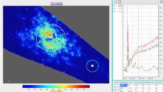 Wheal flare and axon reflex response from intradermal injection [upl. by Nodanrb689]