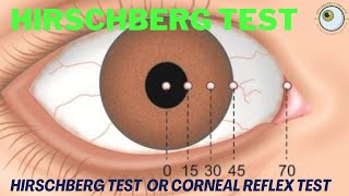 hirschberg corneal reflex tes  how to perform hirschberg test  hirschberg test explained [upl. by Felicdad]