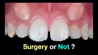 Solving Upper Impacted canines｜【Chris Chang Ortho】CC792 [upl. by Varion]