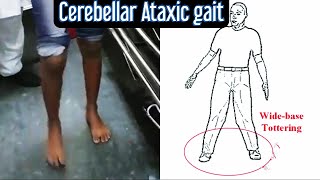 Cerebellar Ataxic Gait giving appearance of drunkenness [upl. by Kopple230]