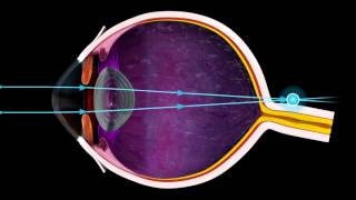 Short Sighted and Long Sighted  3D Medical Animation of the Eye  ABP © [upl. by Nawoj]