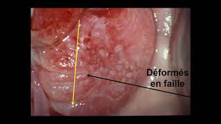 J MARCHETTA  Panorama des aspects colposcopiques  du col normal au cancer [upl. by Aisanahta]