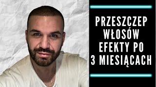 Przeszczep włosów  efekt po 3 miesiącach [upl. by Ailliw]