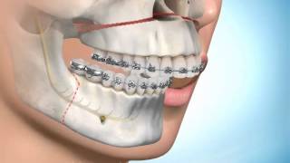 Chirurgie Maxillofaciale et orthodontie [upl. by Natalia]