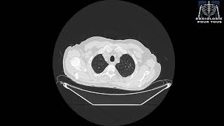 SCANNER THORACIQUE Épanchement pleural gauche responsable d’un collapsus passif du LIG [upl. by Salena268]