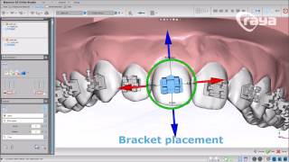 Cementado indirecto de Brackets  3 Formas con Maestro3D Dental Studio  Ortho Studio [upl. by Aketal]