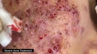 BEST BLACKHEAD AND WHITEHEAD REMOVAL SEVERE ACNE TREATMENT  SATISFYING AND RELAXING VIDEO [upl. by Beryle371]