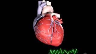 What is Ventricular Fibrillation [upl. by Nosylla913]