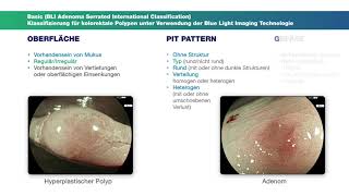 BasicKlassifikation Kolonpolypen [upl. by Fredra]