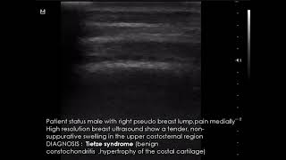 CASE 956 Tietze syndrome [upl. by Monafo]