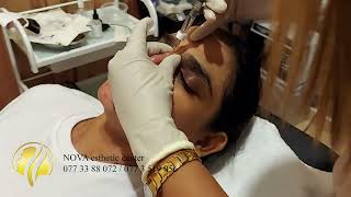 Nose filler novaesthetic24 Sri Lanka [upl. by Rosemaria]