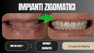 Caso di impianto zigomatico applicato in assenza di osso  Studio Cannizzo Milano [upl. by Nwahsav]