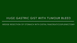 Sleeve gastrectomy with distal pancreaticosplenectomy for Huge gastric GIST [upl. by Jeanelle]