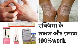 Eczema treatment in Hindi  सालो पुराने दाद का इलाज हिंदी में [upl. by Verda350]