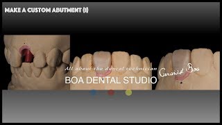 make a custom abutment 1 [upl. by Surdna]