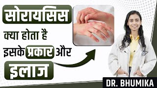 Psoriasis Symptoms Causes and Treatment  Psoriasis Treatment  Dr Bhumika [upl. by Barby]