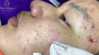 Loan Nguyen Acne Treatment 73b [upl. by Enitsyrk]