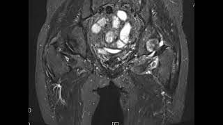 Osteonecrosis of femoral head Lt [upl. by Herve193]