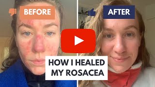 How I Healed My Rosacea The Solution Dermatologists Dont Want You to Know About [upl. by Emera]