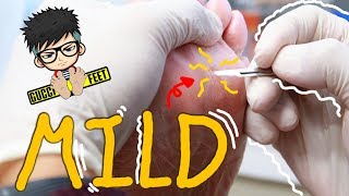 Corn Removal with Callus Mildly Satisfying [upl. by Otrebla]