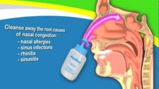 Nasal Irrigation to Treat Sinusitis Common Cold Allergy Better Than Neti Pots [upl. by Holmen]