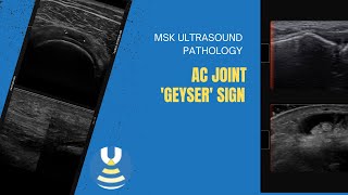 Acromioclavicular joint Geyser sign [upl. by Itsrik]