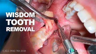 Wisdom tooth removal in 5 MIN or less Surgical Guide Online Course  Free eBook [upl. by Filiano]