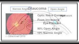 Glaucoma 3 Narrow Angle [upl. by Yesor300]