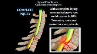 Spinal Cord Injury Complete Or Incomplete  Everything You Need To Know  Dr Nabil Ebraheim [upl. by Annehs]