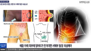 용인세브란스병원 로봇으로 서혜부 탈장 수술 실시 [upl. by Senilec]