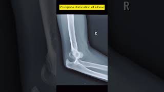 Complete Dislocation of Elbow radiological [upl. by Comethuauc]