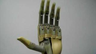 Drew Hittenberger amp Assoc i Limb Prosthetic Handavi [upl. by Nivle]