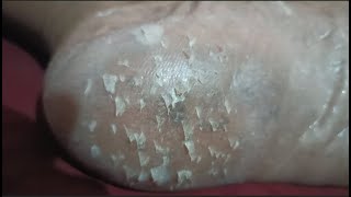 cleansing the skin of the soles of the feet  Removal Callus [upl. by Lorant128]