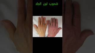 اعراض تدل انك مصاب بالأنيميا احزرها [upl. by Atinod]