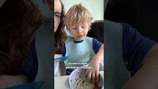 Is my toddler always hungry Let’s talk PraderWilli Syndrome [upl. by Inoj366]