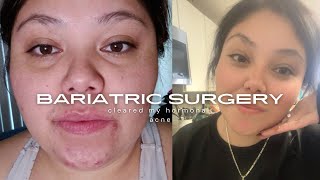 Bariatric surgery cleared my hormonal acne [upl. by Mozza775]