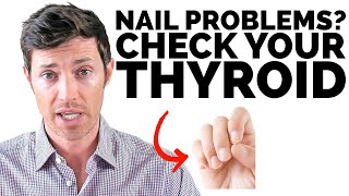 What Your Nails Tell You About Your Thyroid Health [upl. by Yleen213]