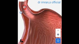 Esophegial squamus cell carcinoma [upl. by Lhok41]