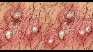 Ingrown hair removal 02 [upl. by Ruamaj]