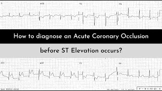 STEMINSTEMI vs OMINOMI A Paradigm Shift in ECG interpretation of MI [upl. by Salohci]