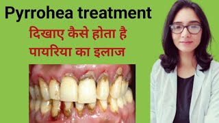 Pyrrohea treatmentपायरिया का इलाजपायरिया का इलाज कैसे होता हैमसूड़ों के बीमारी कैसे ठीक करे [upl. by Nahtiek]