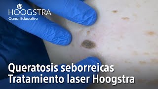 Queratosis seborreicas  Tratamiento laser Hoogstra  22134 [upl. by Mena]