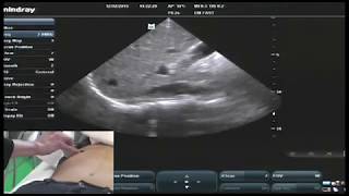 Hot Tips  IVC Volume Assessment with Ultrasound [upl. by Marena]