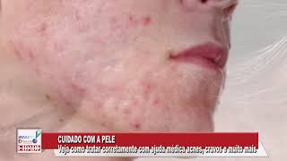 TRATAMENTO DE CASOS MAIS GRAVES DA ACNE [upl. by Gerrilee]