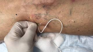 Treating Reticular Veins with Foam Sclerotherapy [upl. by Hertha362]