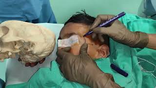 Suprazygomatic approach maxillary nerve block Our take [upl. by Cia]